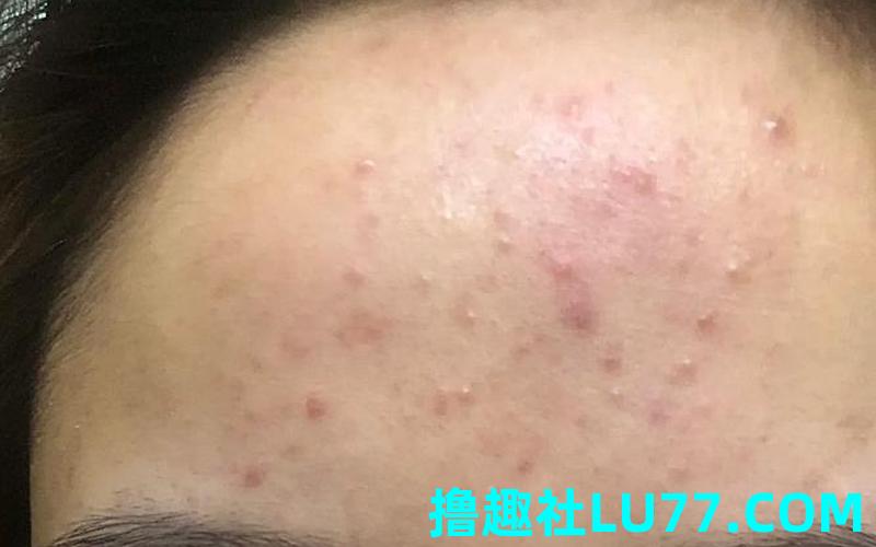 梦见自己额头长痘痘 梦见自己额头长痘痘