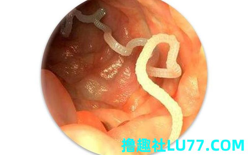 梦见肛门里爬出虫子 梦见肛门里爬出虫子