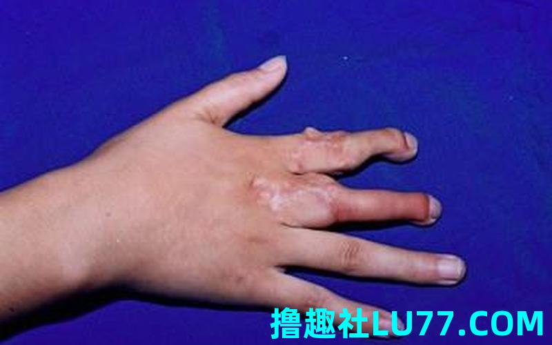梦见别人手没了